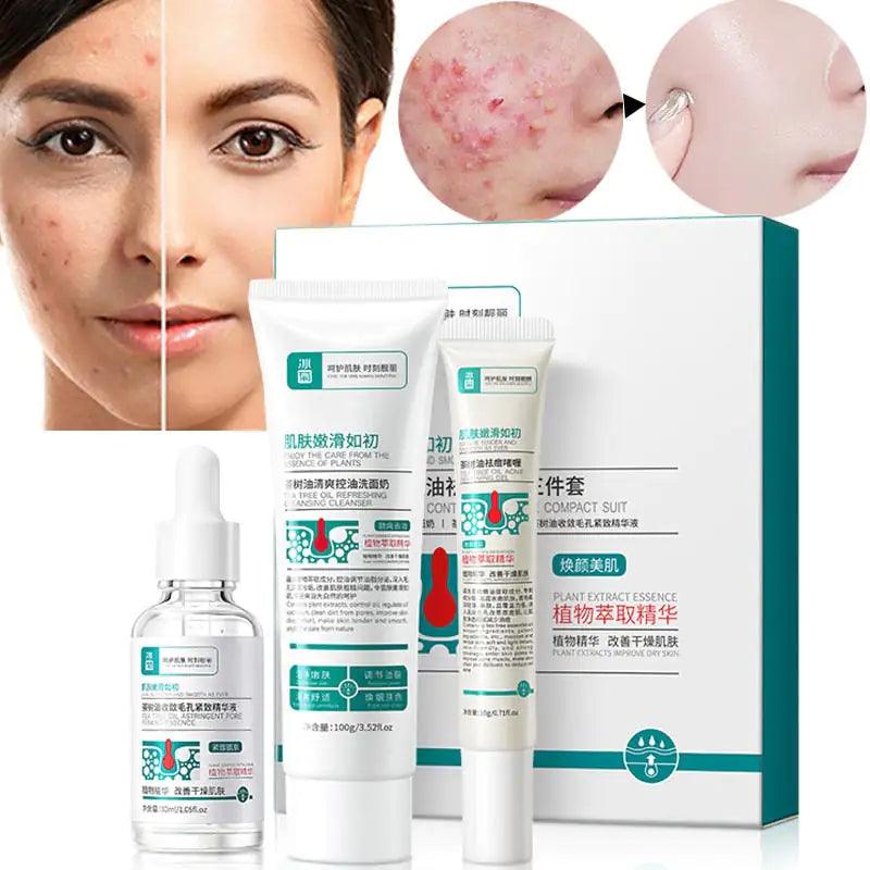 Anti Acne Removal Moisturizing Face Skin Care Kit - EverYouth Essentials